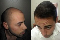 תמונות לפני ואחרי השתלת שיער מטופל מדנמרק